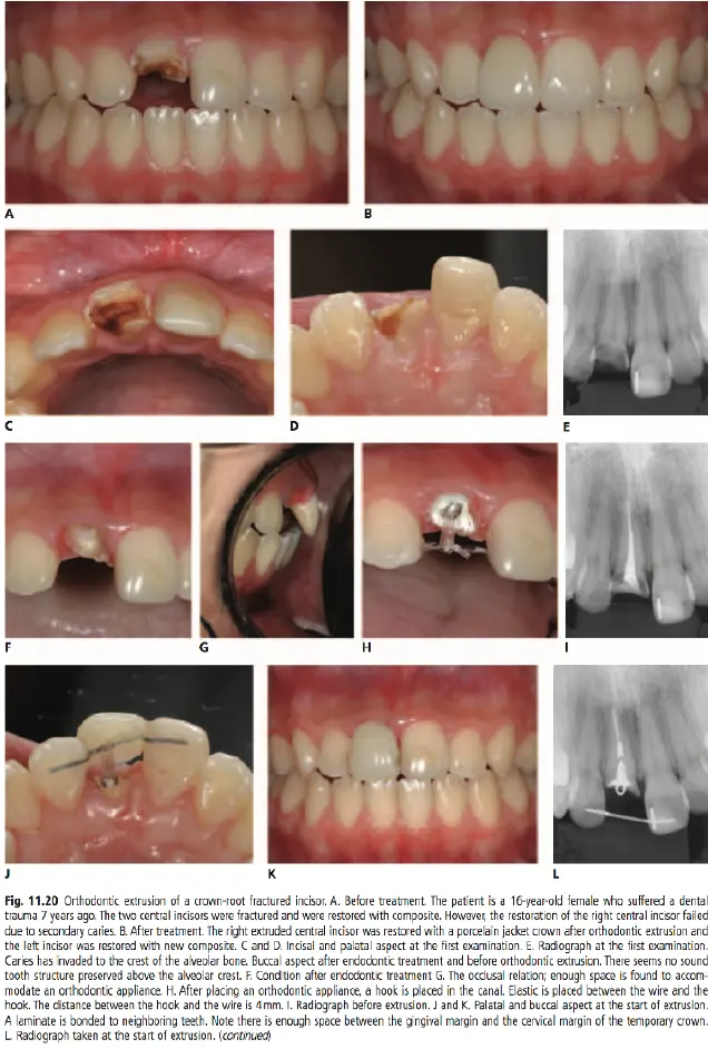 Dentoalveolar Trauma-1765350772180.webp