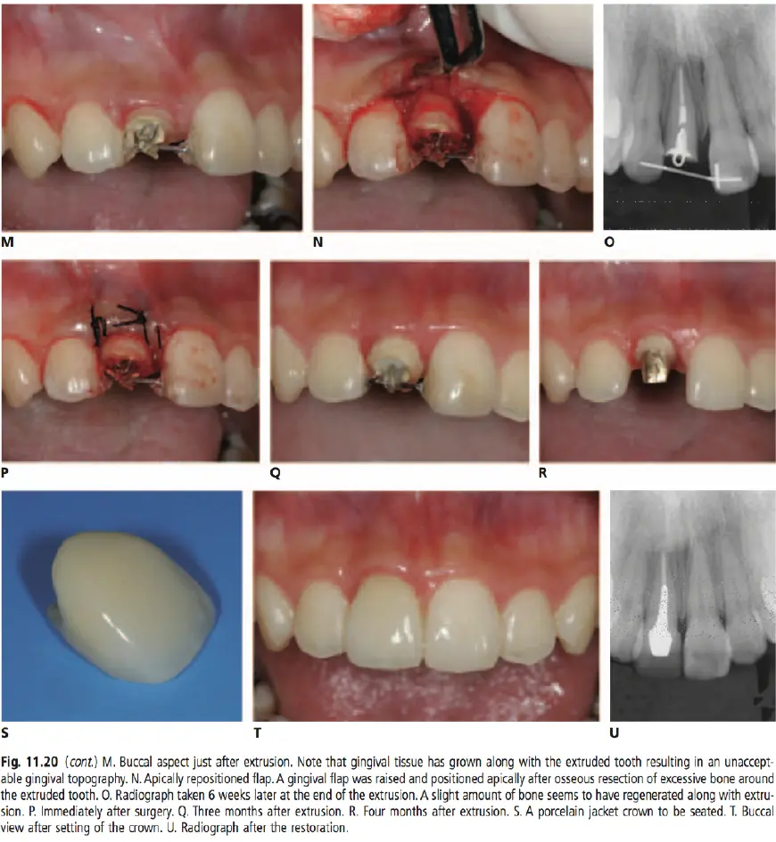 Dentoalveolar Trauma-1765350784657.webp