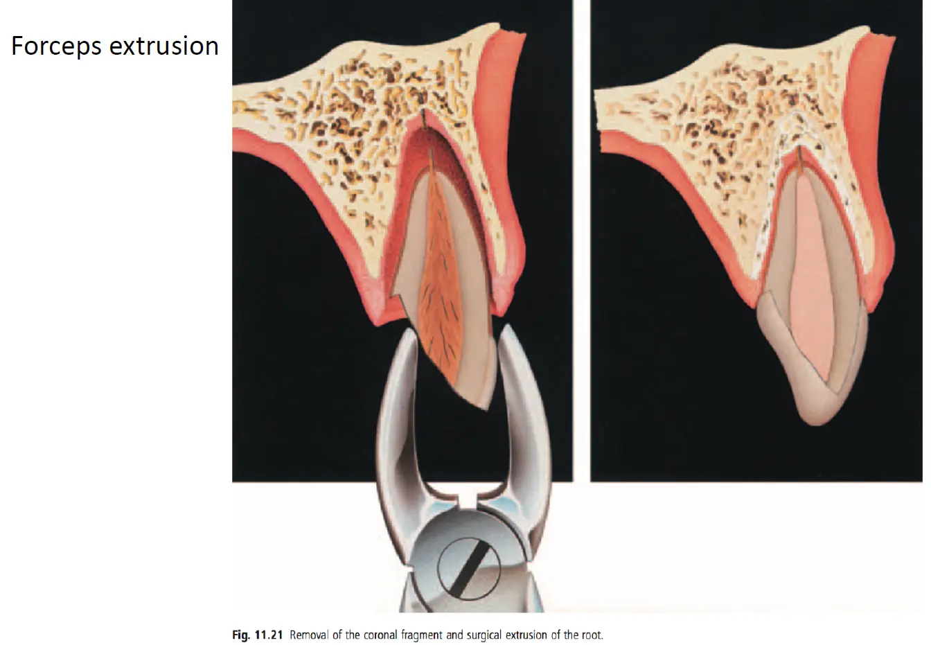 Dentoalveolar Trauma-1765350809164.webp