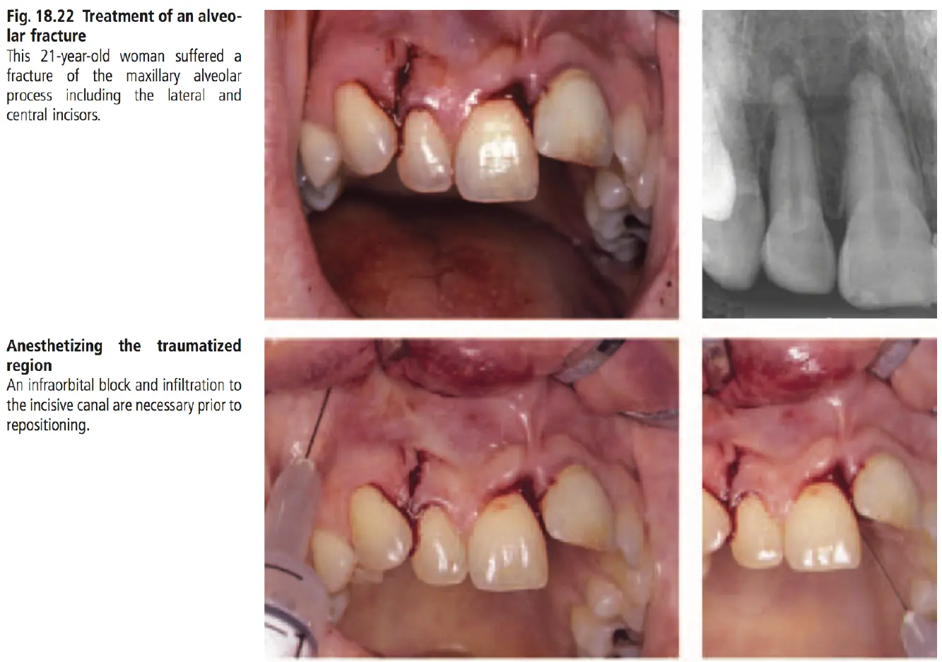 Dentoalveolar Trauma-1765351476295.webp