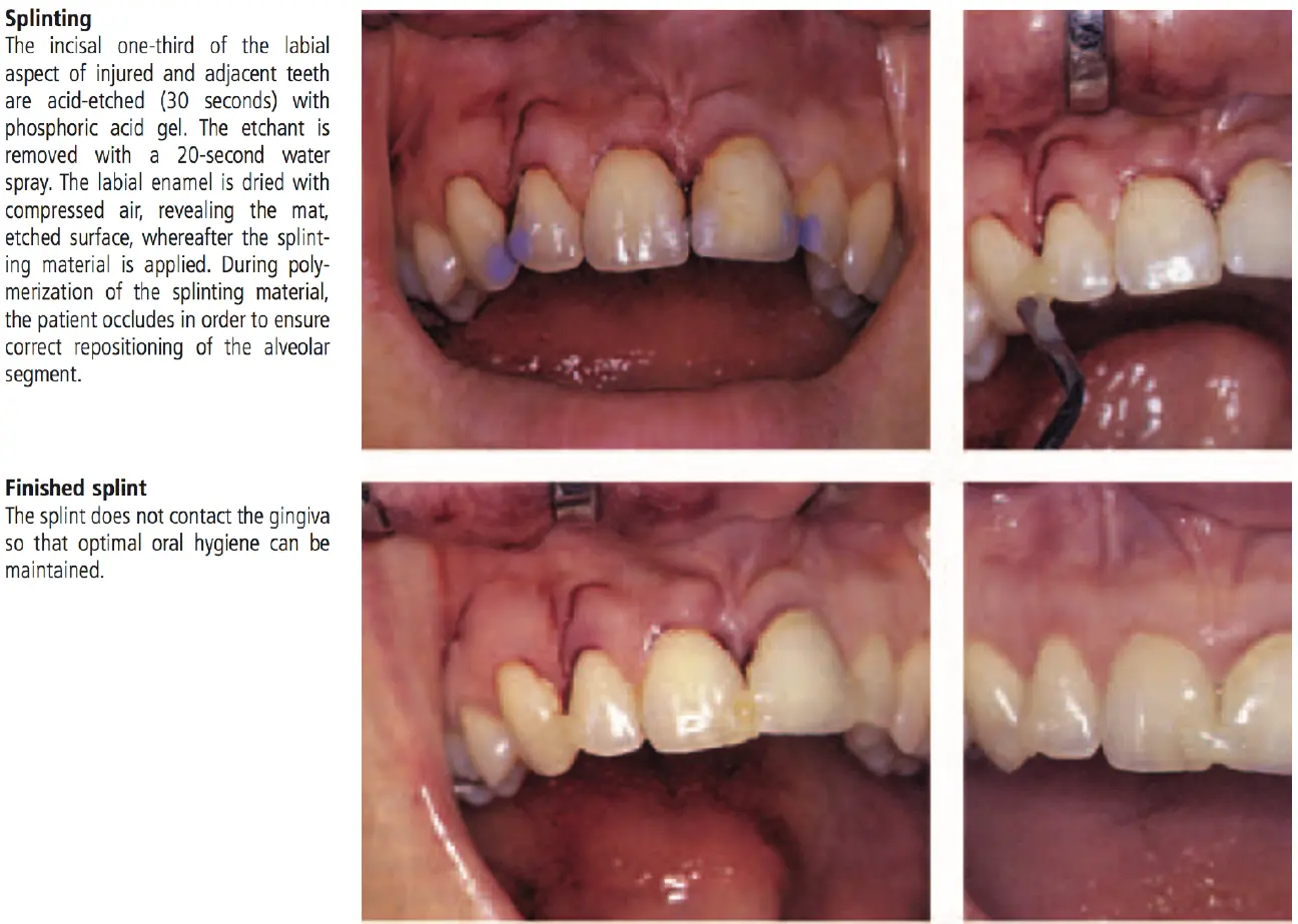 Dentoalveolar Trauma-1765351497168.webp