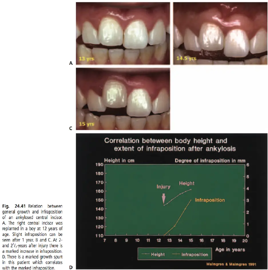 Dentoalveolar Trauma-1765351777721.webp