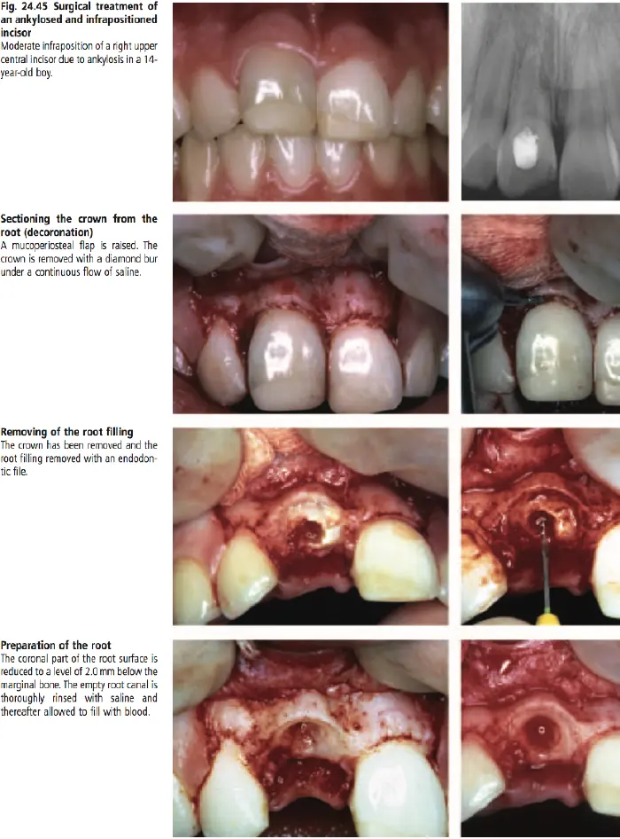 Dentoalveolar Trauma-1765351838442.webp