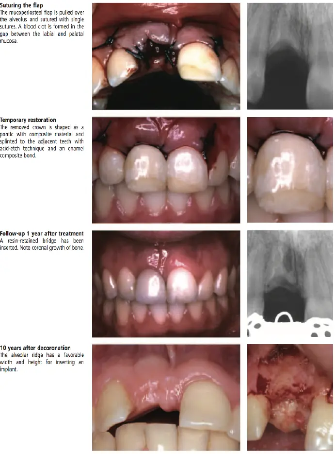 Dentoalveolar Trauma-1765351846822.webp