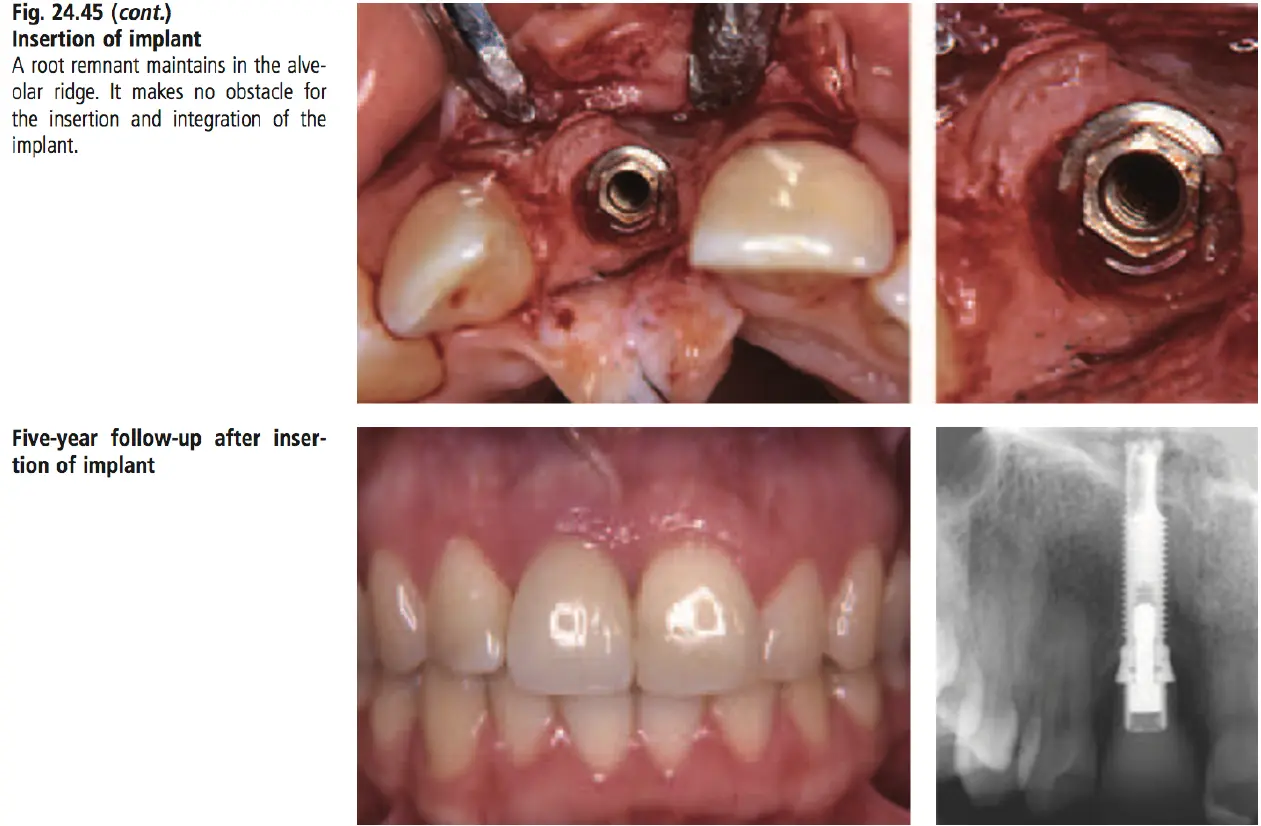 Dentoalveolar Trauma-1765351864848.webp