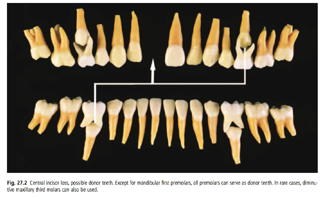 Dentoalveolar Trauma-1765351897681.webp