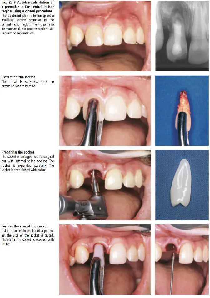 Dentoalveolar Trauma-1765351965883.webp