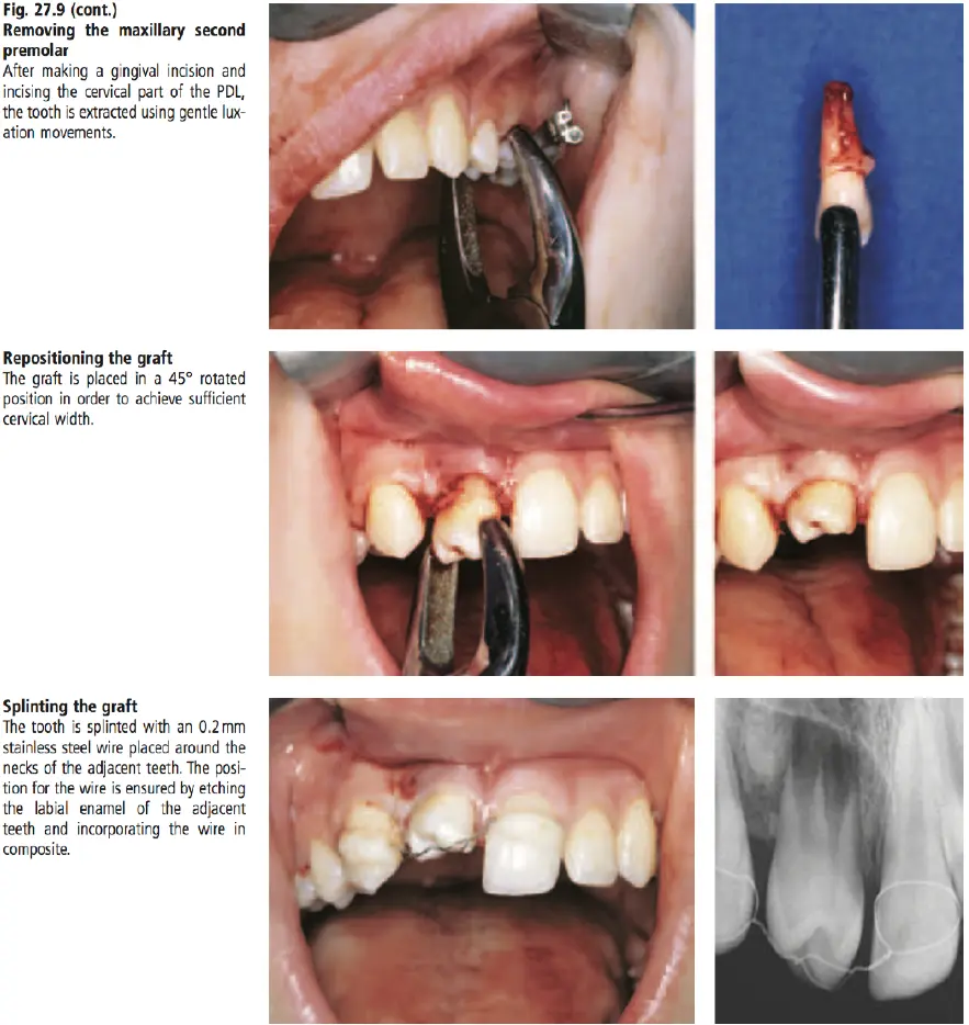 Dentoalveolar Trauma-1765351974240.webp