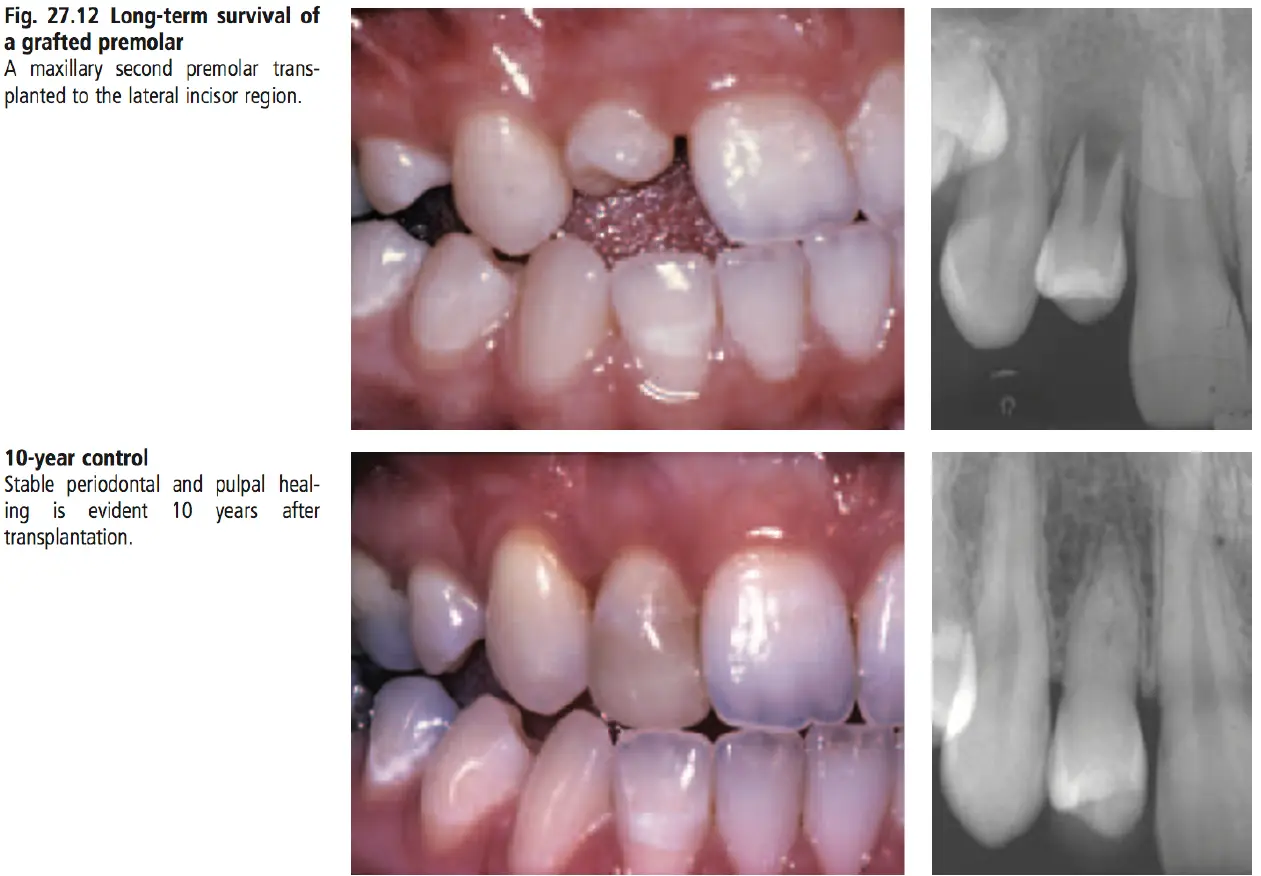 Dentoalveolar Trauma-1765351984156.webp
