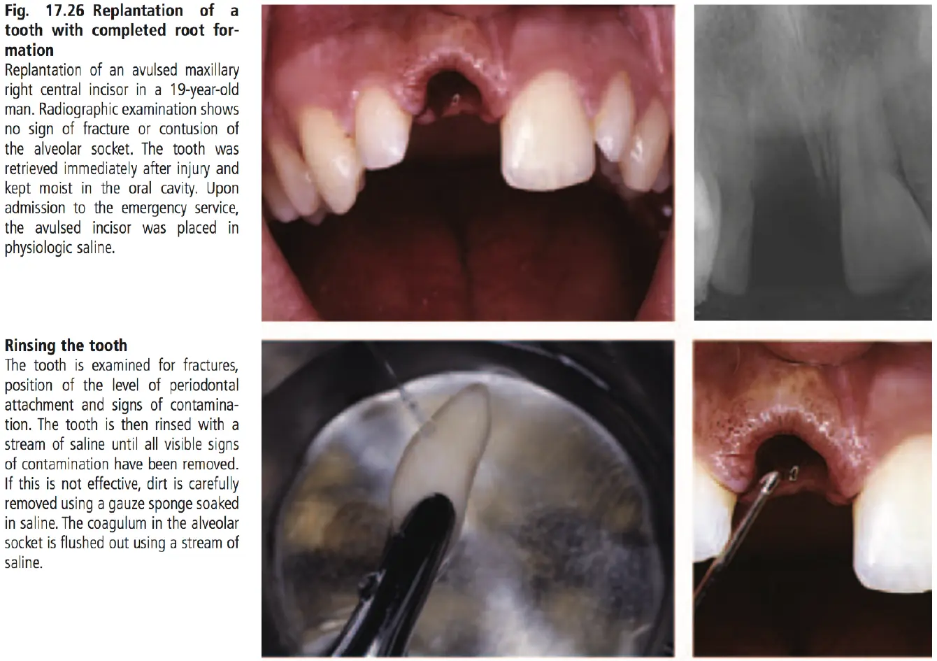 Dentoalveolar Trauma-1765352038589.webp