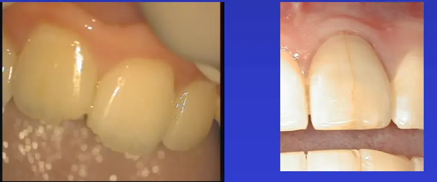 Diagnosis and Management of Cracked & Fractured Teeth-1765430679921.webp