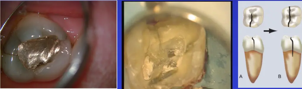 Diagnosis and Management of Cracked & Fractured Teeth-1765430722074.webp