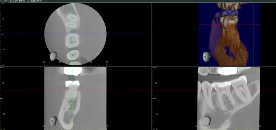 Diagnosis and Management of Cracked & Fractured Teeth-1765430741374.webp