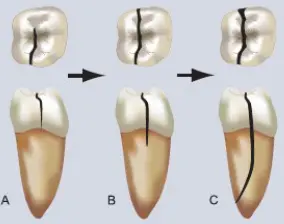 Diagnosis and Management of Cracked & Fractured Teeth-1765430777520.webp