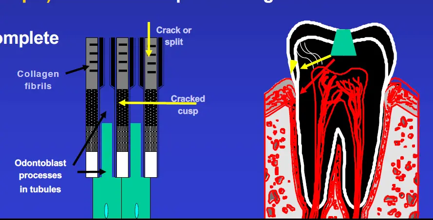 Diagnosis and Management of Cracked & Fractured Teeth-1765430818641.webp