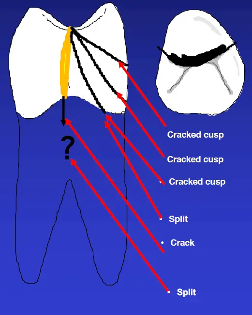 Diagnosis and Management of Cracked & Fractured Teeth-1765430912130.webp329x410