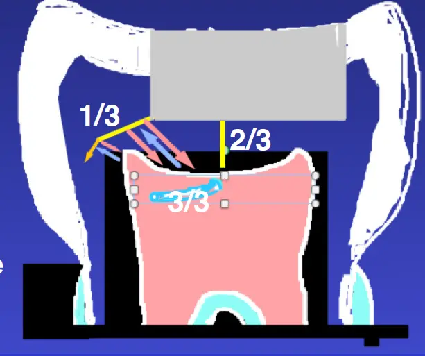 Diagnosis and Management of Cracked & Fractured Teeth-1765431090504.webp