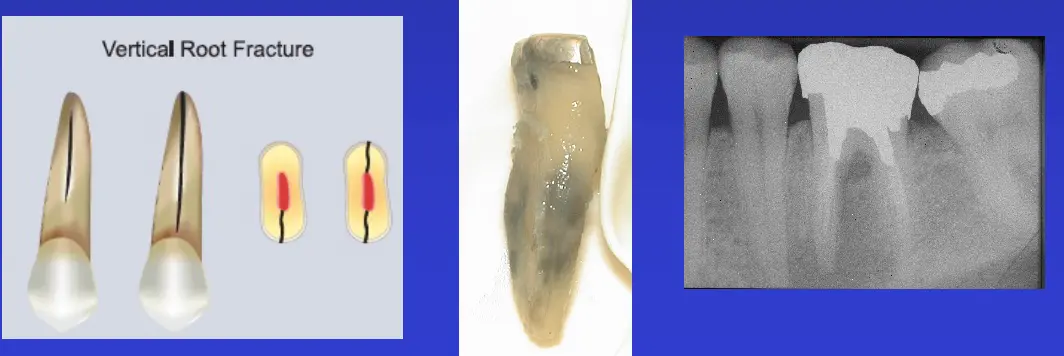 Diagnosis and Management of Cracked & Fractured Teeth-1765431160097.webp