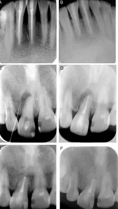 Diagnosis and Management of Cracked & Fractured Teeth-1765431285384.webp