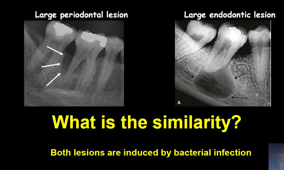 Diagnosis and management of concurrent endodontic and periodontal diseases-1765177642570.webp