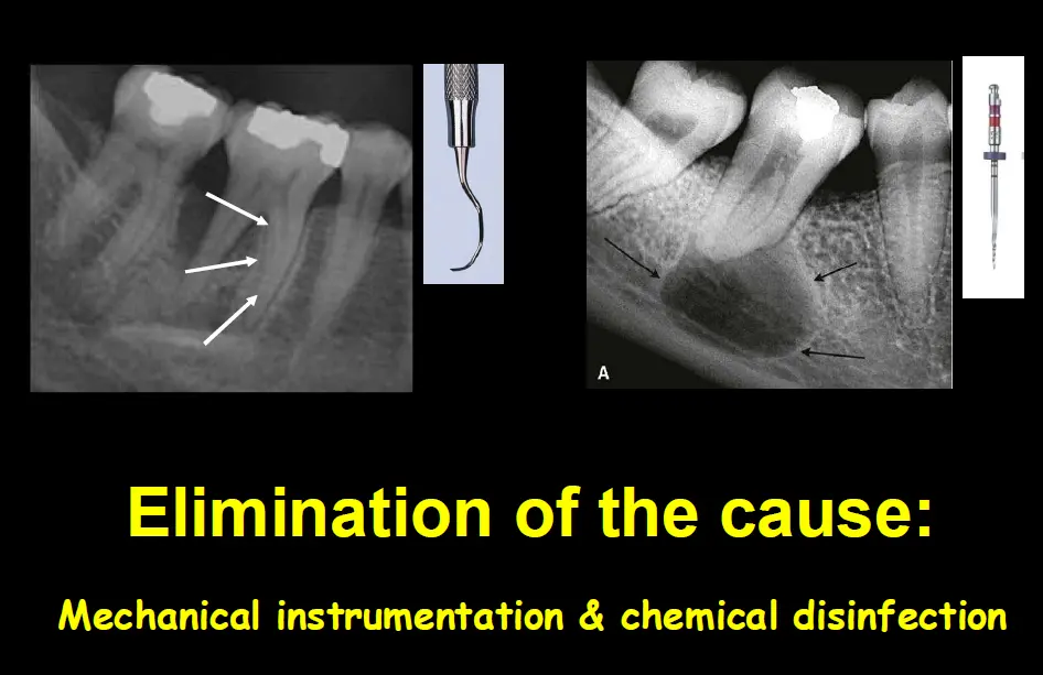 Diagnosis and management of concurrent endodontic and periodontal diseases-1765177684356.webp