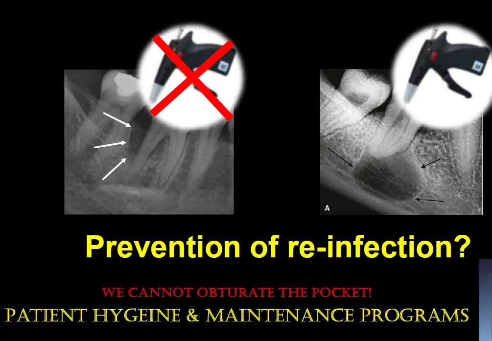 Diagnosis and management of concurrent endodontic and periodontal diseases-1765177696601.webp430x298