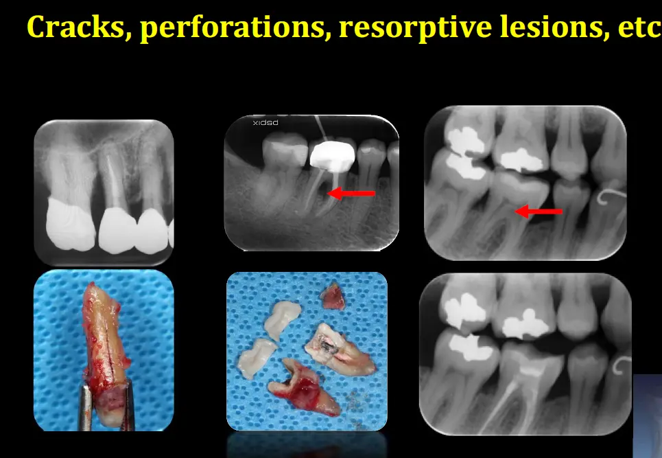 Diagnosis and management of concurrent endodontic and periodontal diseases-1765177888938.webp580x401