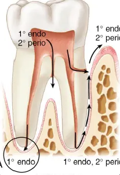 Diagnosis and management of concurrent endodontic and periodontal diseases-1765178263520.webp