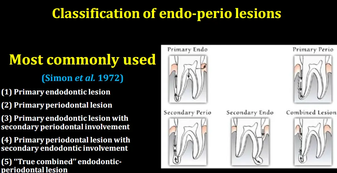 Diagnosis and management of concurrent endodontic and periodontal diseases-1765178292621.webp