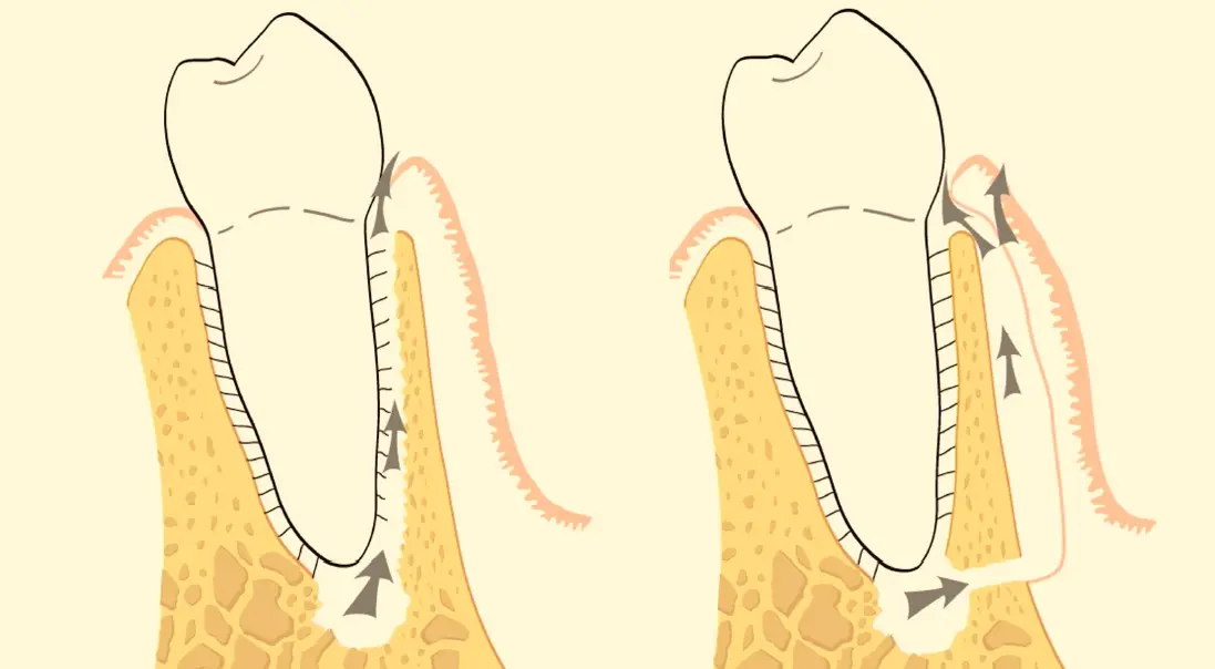 Diagnosis and management of concurrent endodontic and periodontal diseases-1765178494459.webp526x290