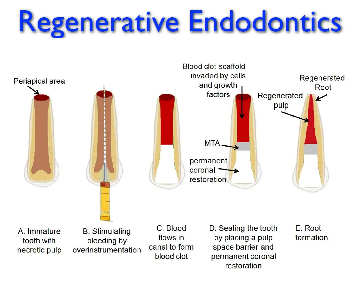 Endodontic Management of Immature Teeth-1765464244760.webp