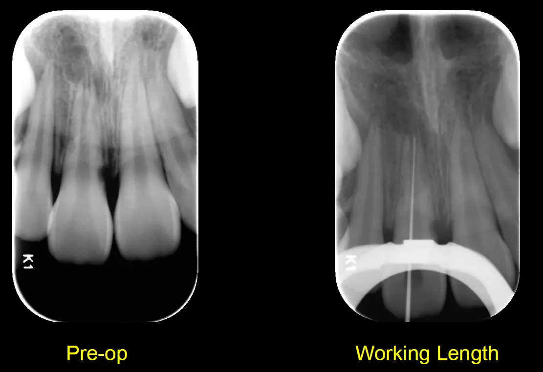Endodontic Management of Immature Teeth-1765464266678.webp