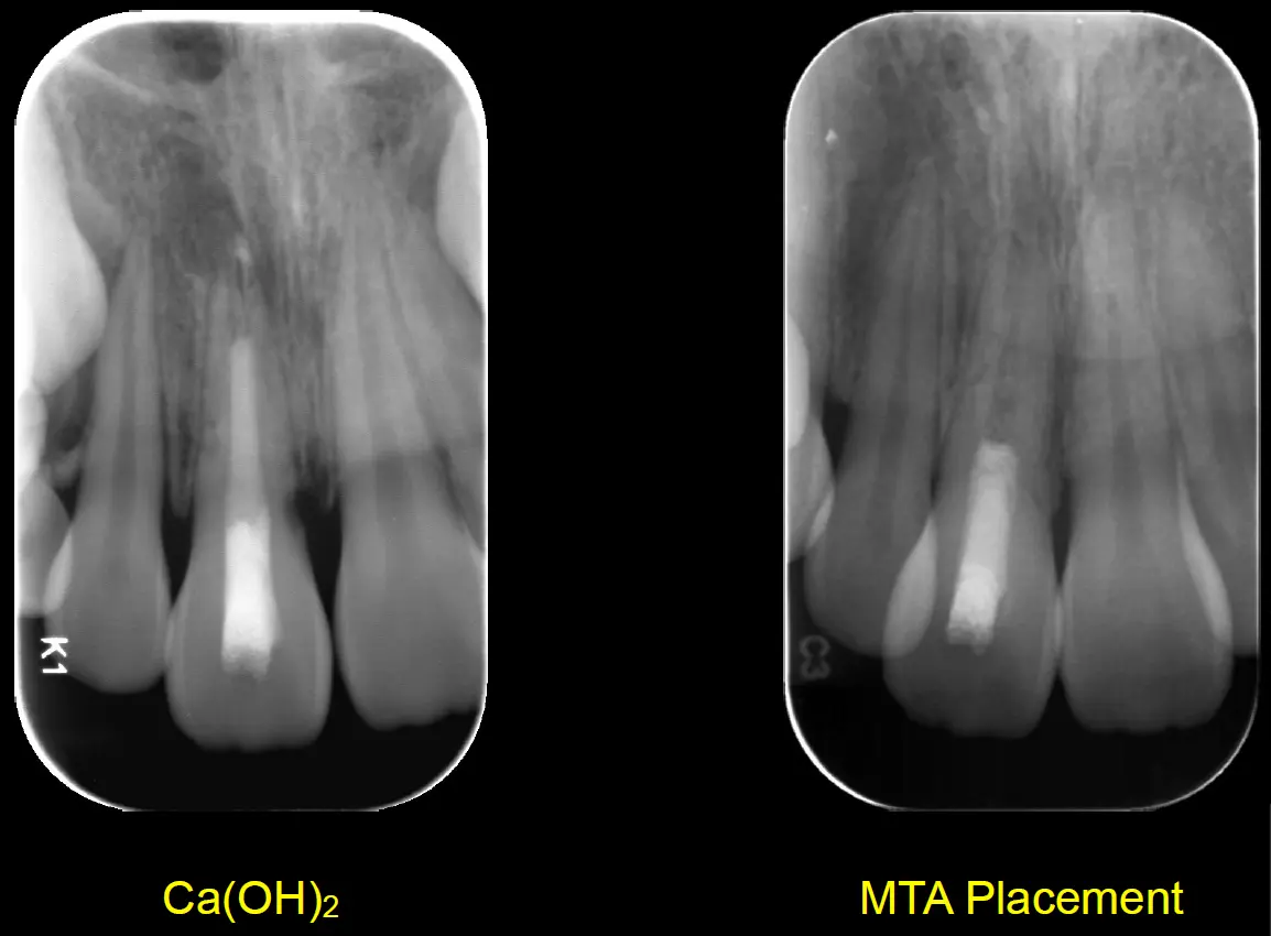 Endodontic Management of Immature Teeth-1765464275234.webp