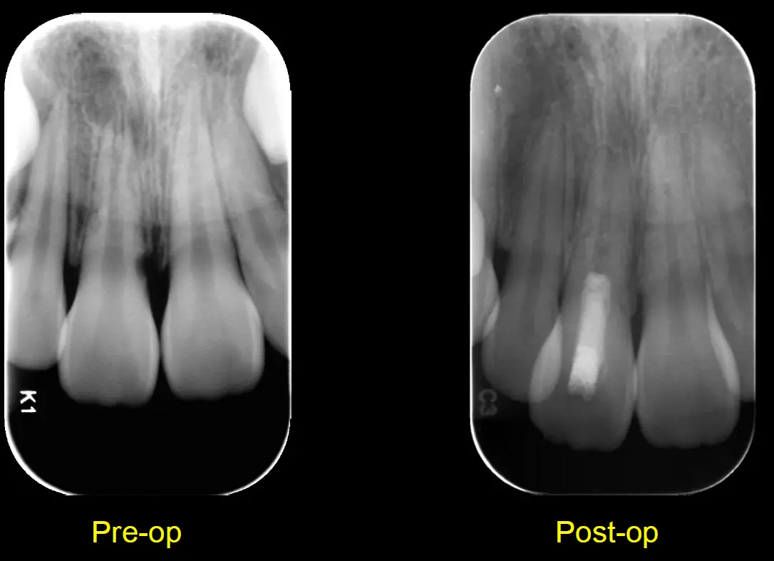 Endodontic Management of Immature Teeth-1765464281871.webp