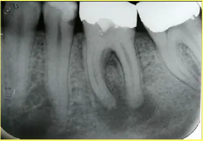 Endodontic Radiography and Working length determination-1764861164097.webp