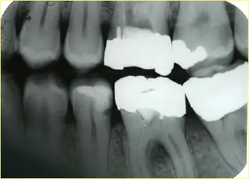 Endodontic Radiography and Working length determination-1764861281462.webp