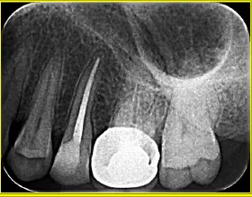 Endodontic Radiography and Working length determination-1764861356367.webp
