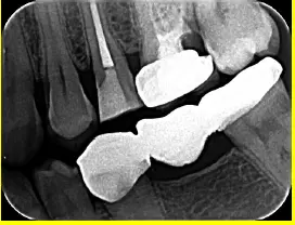 Endodontic Radiography and Working length determination-1764861365071.webp