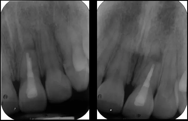 Endodontic Radiography and Working length determination-1764861427251.webp
