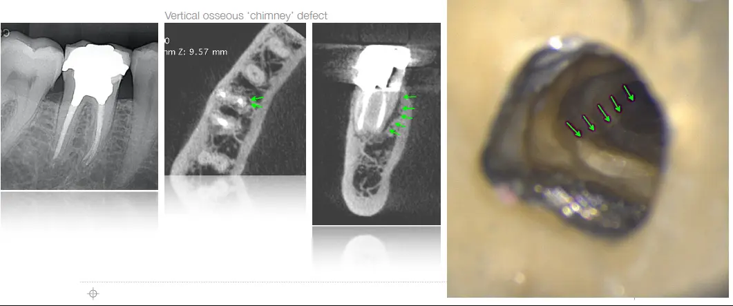 Endodontic Retreatment Case Selection & Procedures-1765437570087.webp