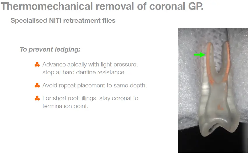 Endodontic Retreatment Case Selection & Procedures-1765439191175.webp