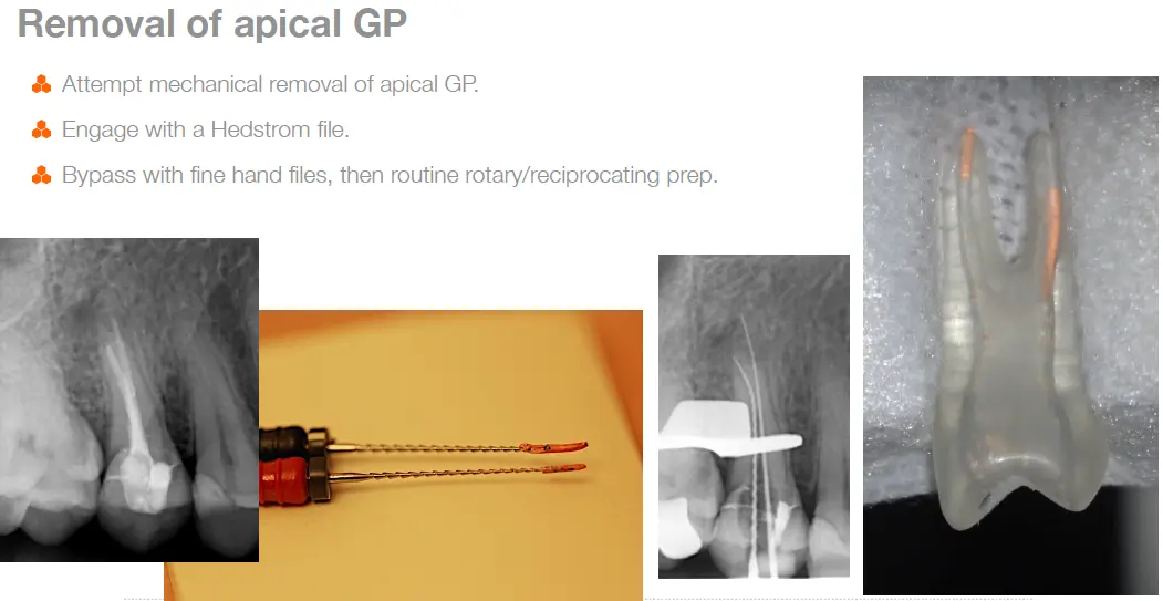 Endodontic Retreatment Case Selection & Procedures-1765439206399.webp