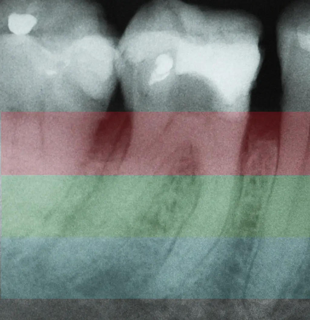 Endodontic procedural errors and their management-1765108595922.webp329x340
