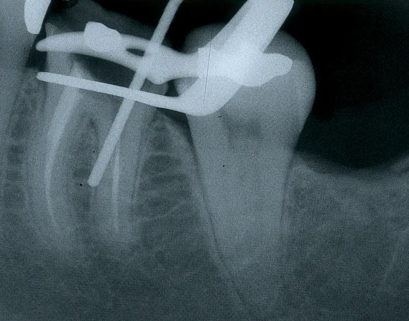 Endodontic procedural errors and their management-1765114826840.webp431x338