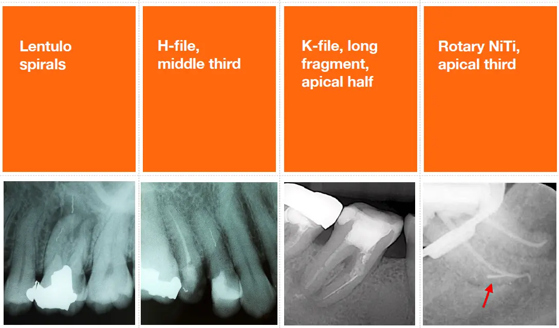 Endodontic procedural errors and their management-1765115189197.webp554x325