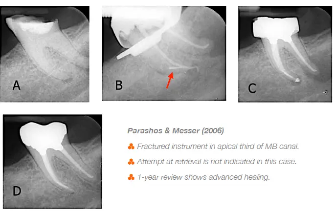 Endodontic procedural errors and their management-1765155625112.webp