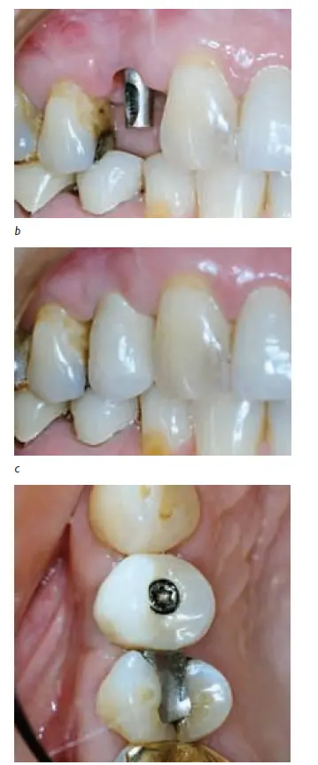 Implants-1781439523102.webp