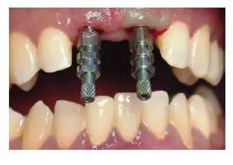 Implants-1781439562997.webp