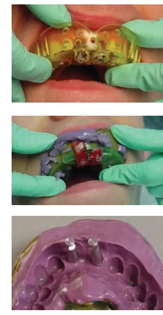 Implants-1781439581246.webp