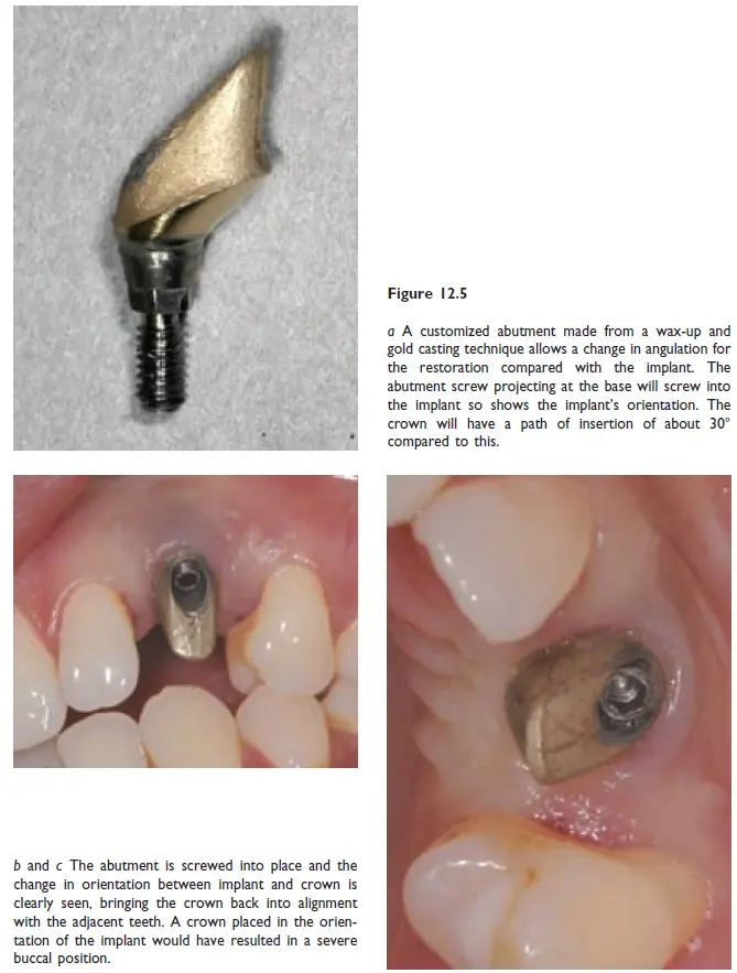 Implants-1781439695668.webp426